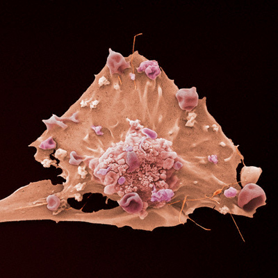 У трижды негативного рака груди нашли слабое место